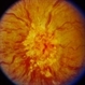 Central Retinal Vein Occlusion (CRVO)