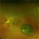 Congenital Hypertrophy of the Retinal Pigment Epithelium Wide Field Optomap Congenital Hypertrophy of the Retinal Pigment Epithelium Wide Field Optomap