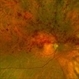 Hemiretinal Vein Occlusion Hemiretinal Vein Occlusion