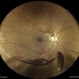Subhyaloid Hemorrhage in a Case of Proliferative Diabetic Retinopathy