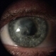 Herpetic Keratitis