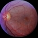 Pattern Dystrophy / Myotonic Dystrophy