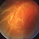 Retinal Detachment with Proliferative Vitreoretinopathy Retinal Detachment with Proliferative Vitreoretinopathy