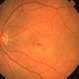 Recurrent Subfoveal CNVM Recurrent Subfoveal CNVM