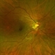 Roth Spots - Bacterial Endocarditis Roth Spots - Bacterial Endocarditis