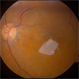 Full  Thickness Macular Hole Full  Thickness Macular Hole