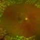 Retinectomy in Complex Retinal Detachment Retinectomy in Complex Retinal Detachment