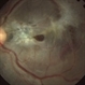 Traumatic Macular Hole Traumatic Macular Hole