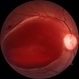 Macular Hemorrhage Secondary to Anemic Retinopathy