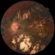 Pigmented Paravenous Retinochoroidal Atrophy Pigmented Paravenous Retinochoroidal Atrophy