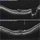 Inverted ILM Flap in RD with FTMH-First Post Op Day Inverted ILM Flap in RD with FTMH-First Post Op Day