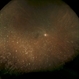 Asteroid Hyalosis