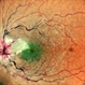 ANAEMIC RETINOPATHY