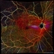 Branch Retinal Vein Occlusion with Macular Edema Branch Retinal Vein Occlusion with Macular Edema