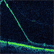 Retinoschisis with Outer Layer Break Retinoschisis with Outer Layer Break