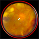 Proliferative Diabetic Retinopathy: Smartphone Fundus Image Proliferative Diabetic Retinopathy: Smartphone Fundus Image