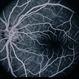 Multiple Sclerosis