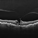 Stage 2 Macular Hole From VMT Stage 2 Macular Hole From VMT
