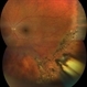 Retinitis scleropetaria following BB injury left eye