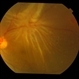Retinal Fold Near Retinal Break in Rhegmatogenous Retinal Detachment
