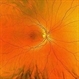 Congenital Retinal Macrovessel Congenital Retinal Macrovessel