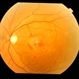 Perifoveal Telangiectasia With CNVM