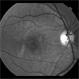 DUSN (Diffuse Unilateral Subacute Neuroretinitis) DUSN (Diffuse Unilateral Subacute Neuroretinitis)