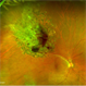 Cavernous Hemangioma