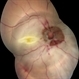 Post Traumatic Optic Nerve Head Avulsion Post Traumatic Optic Nerve Head Avulsion