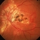 Histoplasmosis and Old Disciform Macular Scar Histoplasmosis and Old Disciform Macular Scar