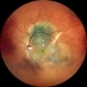 RPE rip in a case of Idiopathic polypoidal choroidopathy