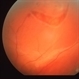 Retinal Tear with Detachment