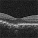 Focal Choroidal Excavation