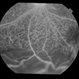 Uveitis With Exudative Retinal Detachment