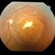 Heredomacular Degeneration