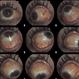 External Photography of  Likely Xanthogranuloma External Photography of  Likely Xanthogranuloma