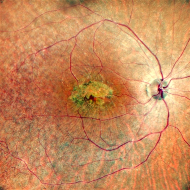 Macular Dystrophy Retina Image Bank macular-dystrophy-retina-image-bank