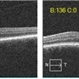 Macular Hole Observed