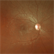 Stargardt's Disease Stargardt's Disease
