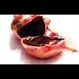 Enucleated Eye with Malignant Melamoma Enucleated Eye with Malignant Melamoma