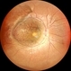 Retinoschisis Retinoschisis