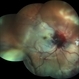 24 Hours Post Scleral Wound Closure+ Scleral Buckle+25 g Vitrectomy+Silicon Oil