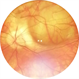 Posterior staphyloma in oculocutaneous albinism