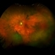 Diffuse uveal melanoma Diffuse uveal melanoma