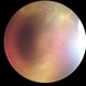 Retinopathy of Prematurity Retinopathy of Prematurity