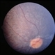 Leber's Congenital Amaurosis