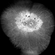 Tapetoretinal Degeneration