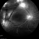 Multifocal Exudative Detachments Due to VKH Multifocal Exudative Detachments Due to VKH