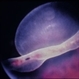 Dislocated Lens With Retinal Detachment