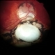 Coloboma Coloboma